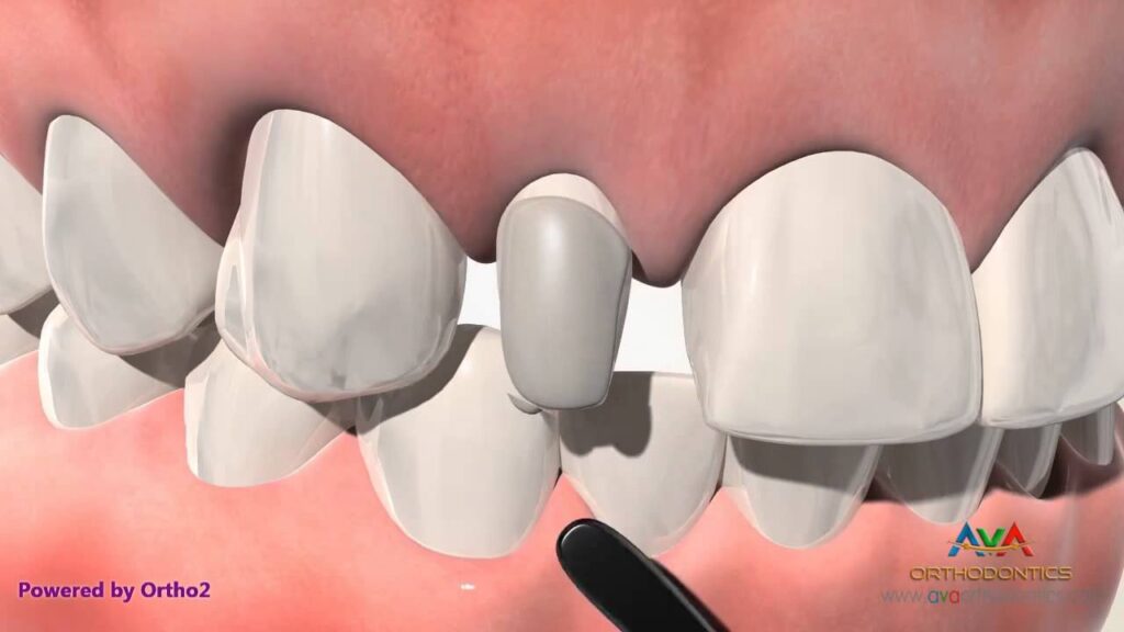 agenesia dental ortodoncia