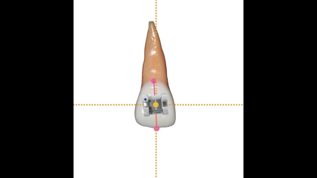 ajustes edgewise ortodoncia