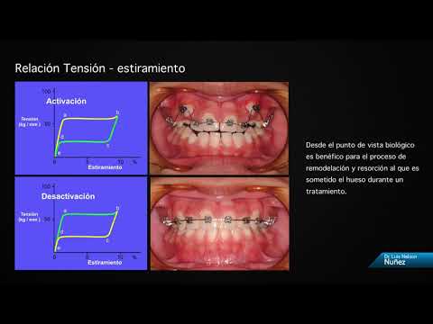 aleaciones superelasticas ortodoncias