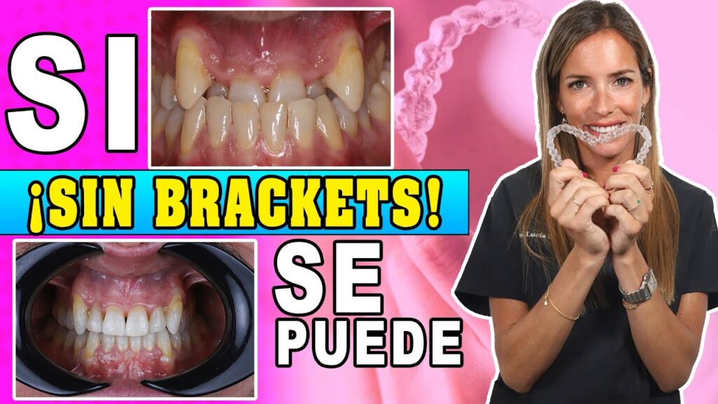 alinear dientes sin ortodoncia