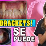 alinear dientes sin ortodoncia