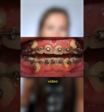 aloovoo aparatos de ortodoncia dientes dentales