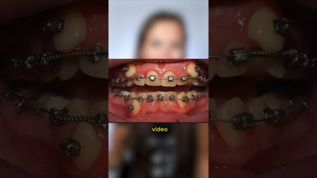 aparato dentral ortodoncia por dentro