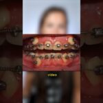 aparato dentral ortodoncia por dentro