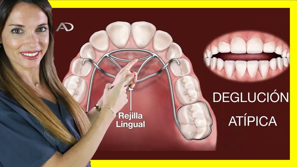 aparato ortodoncia lengua en medio