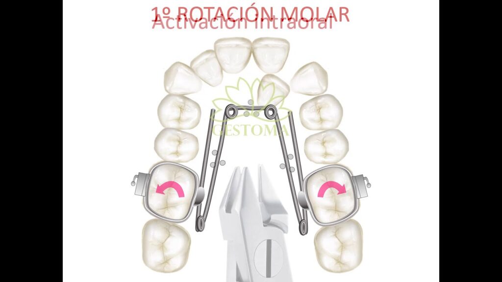 aparato ortodoncia quad helix