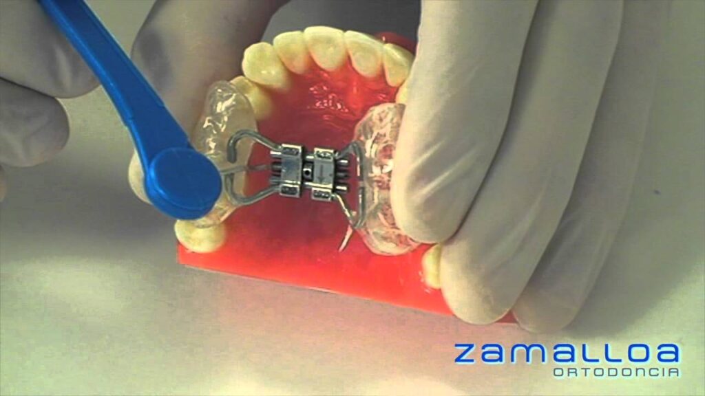 aparato para ensanchar el paladar ortodoncia