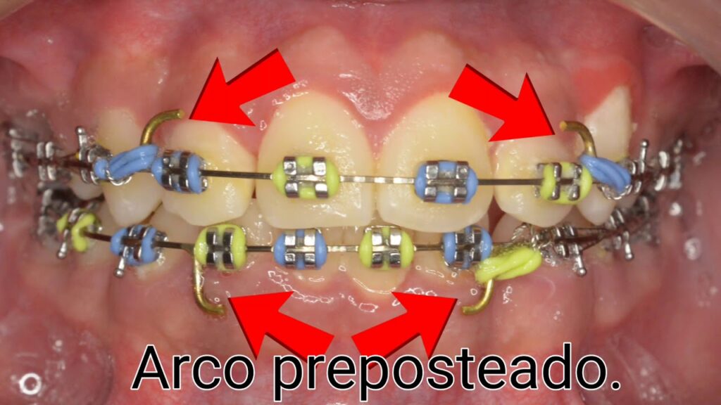arco de cierre ortodoncia por deslizamiento