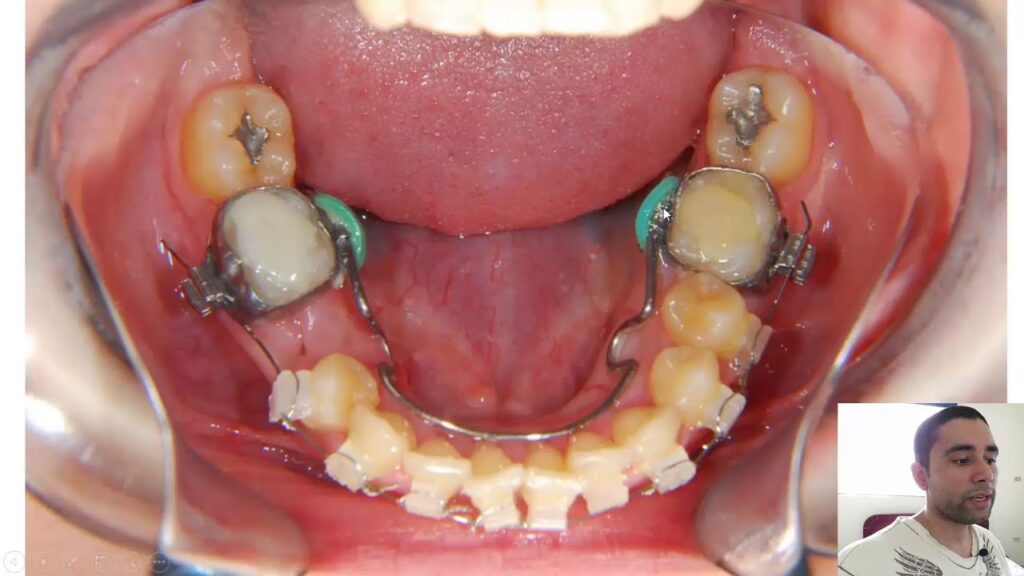 arco lingual ortodoncia para que sirve