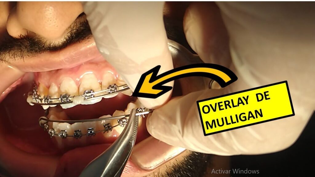 arco overlay ortodoncia como ligar