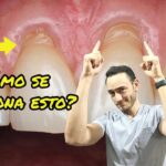 atlas de ortodoncia del adulto recesiones gingivales