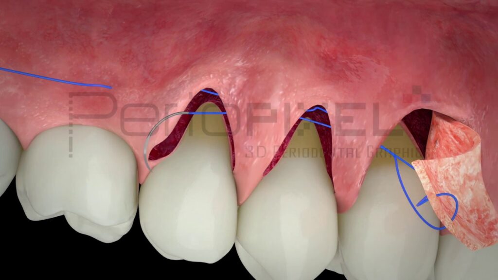 atlas fotografico de recesiones gingivales y pacientes de ortodoncia