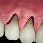 atlas fotografico de recesiones gingivales y pacientes de ortodoncia