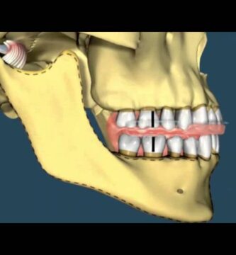 avance mandibular ortodoncia