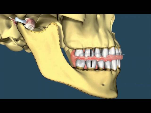 avance mandibular ortodoncia