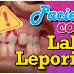 ayuda ortodoncia labio leporino