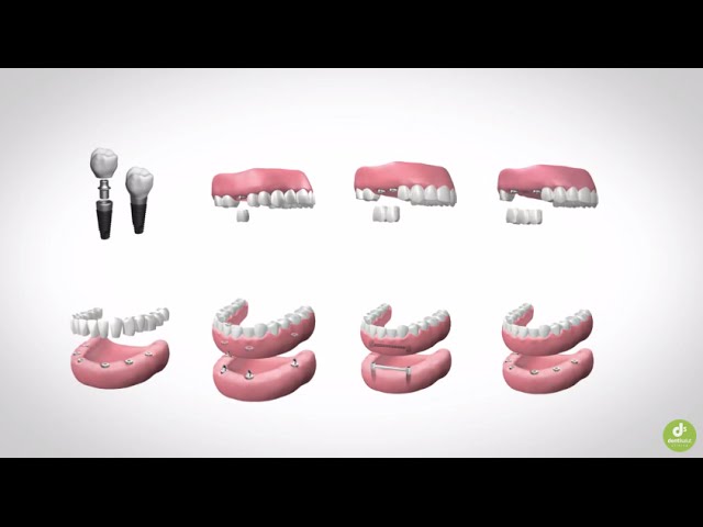 barcelona ortodoncia implante dental