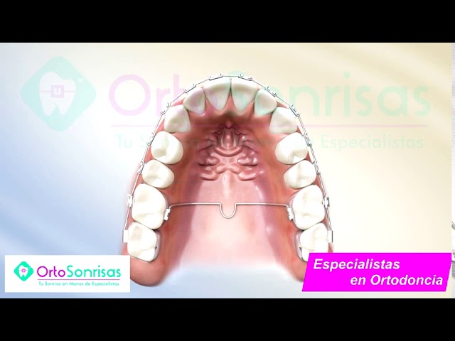 barra palatina o lingual ortodoncia