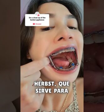 barra posicion de brackets ortodoncia