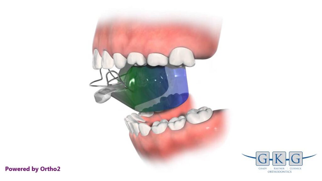 bionatorl ortodoncia