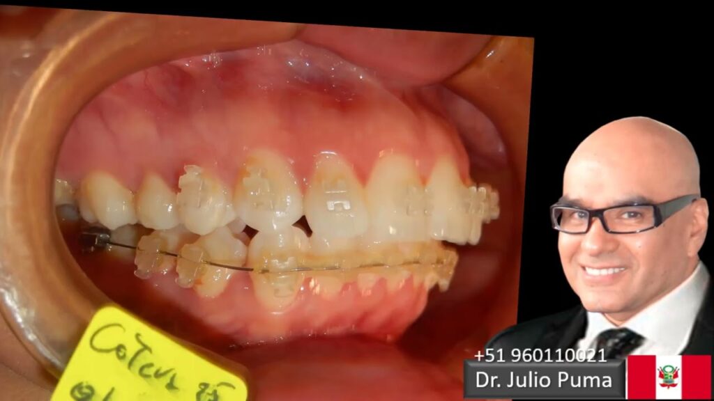 biprotrusion solucion ortodoncia