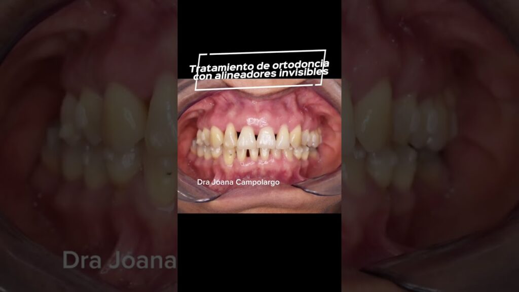 blog periodontitis y ortodoncia