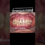 blog periodontitis y ortodoncia