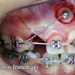 botones de ortodoncia vestibular