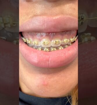 brackets de oro ortodoncia