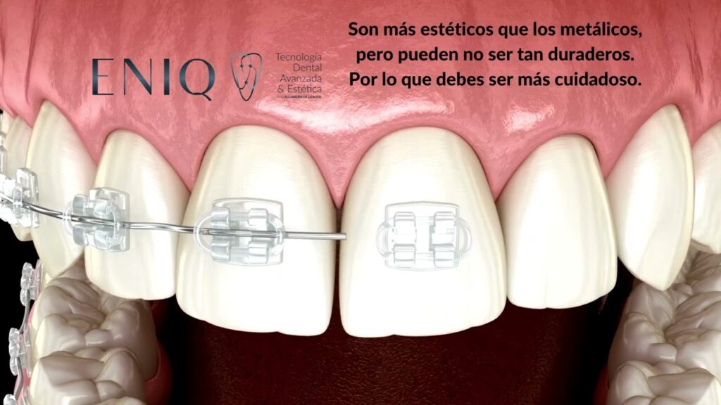 brackets madrid