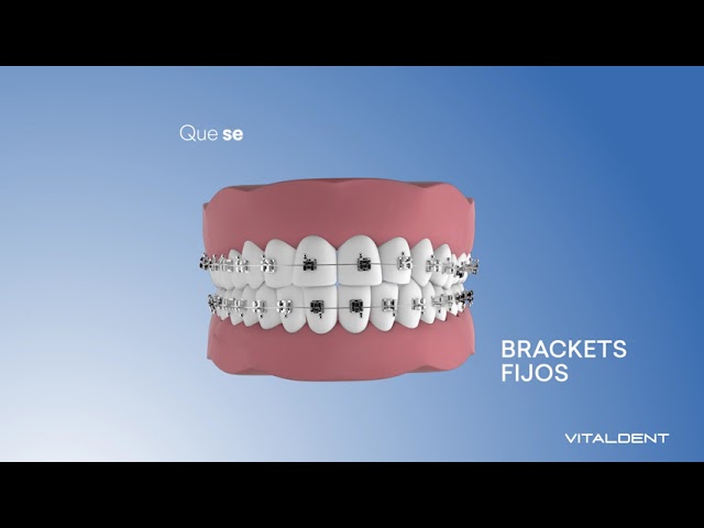 brackets precio vitaldent