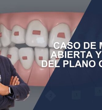 canteo plano oclusal ortodoncia