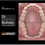 caredent ortodoncia lingual