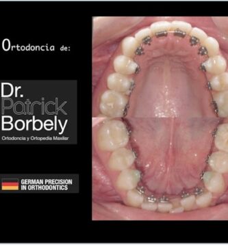 caredent ortodoncia lingual