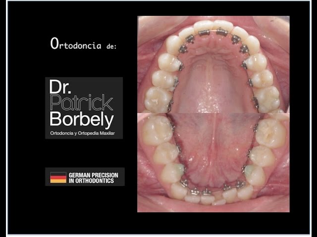 caredent ortodoncia lingual