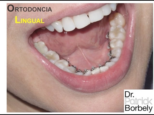 castandental ortodoncia lingual