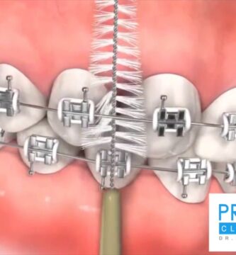 cepillado dental con ortodoncia