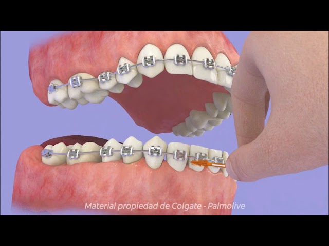 cepillos para limpiar los aparatos de ortodoncia