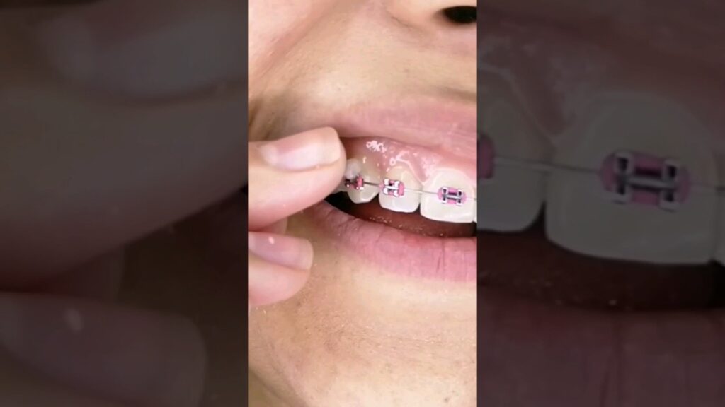 cera dental ortodoncia mercadona