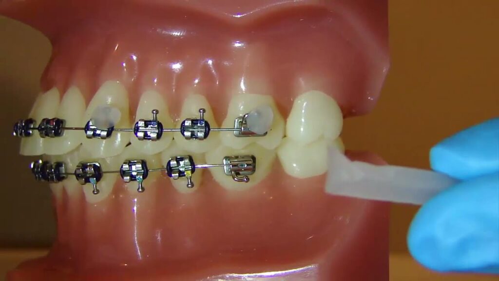 cera dentsl ortodoncia