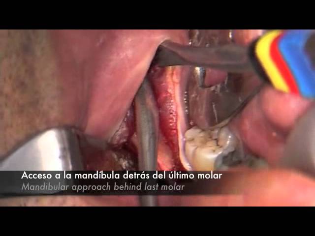 cirugia ortodoncia maxilofacial