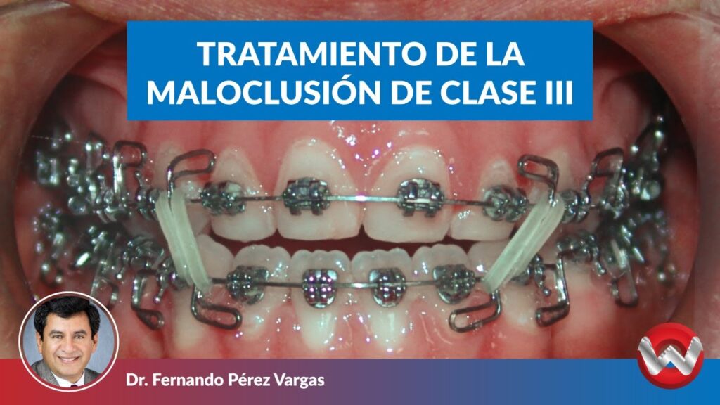 clase 3 dental ortodoncia