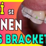 colocacion correcta de brackets en ortodoncia