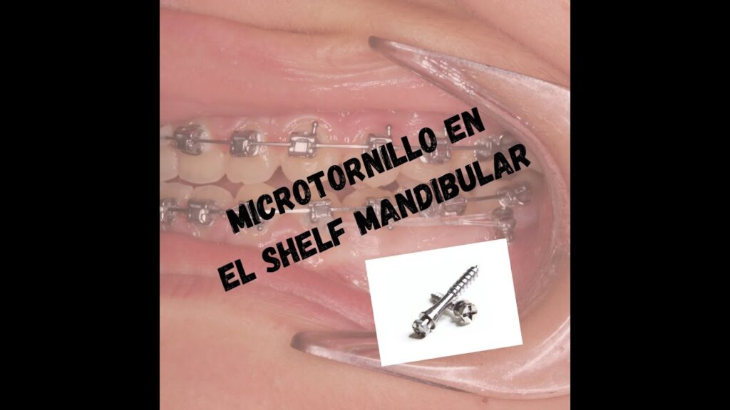 colocacion microtornillos de ortodoncia en rama ascendente mandibular