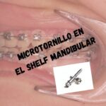 colocacion microtornillos de ortodoncia en rama ascendente mandibular