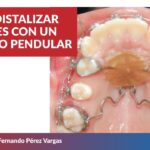 como activar un pendulo en ortodoncia