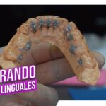 como cementar ortodoncia lingual