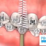 como cepillarse los dientes con ortodoncia