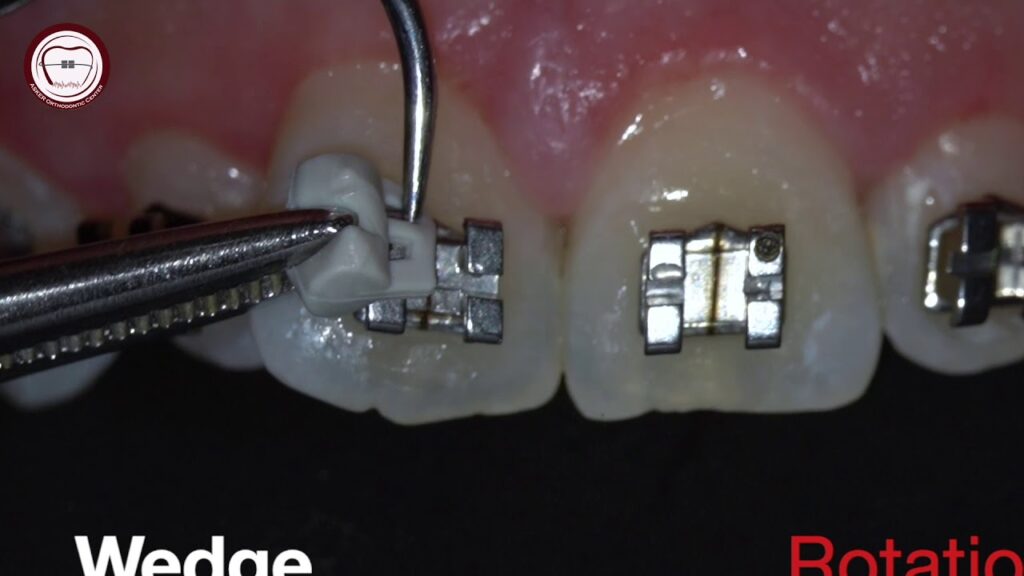 como colocar cuñas de rotacion en ortodoncia