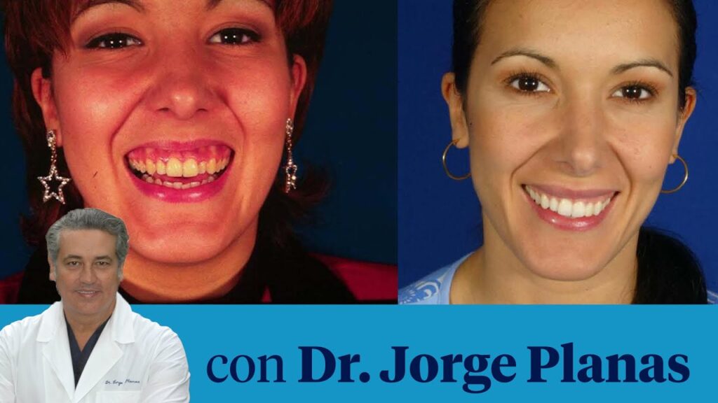 como corregir la sonrisa gingival con ortodoncia